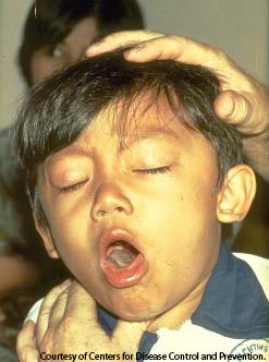 PHOTO: Young boy coughing from Pertussis also known as whooping cough